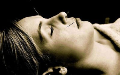 Acupuncture Facelifts Treatment