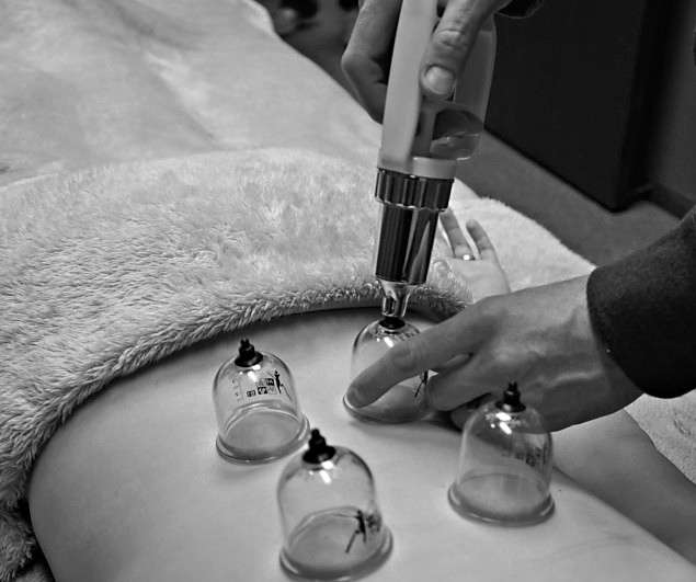 cupping 4 Balanced Body Acupuncture & Chiropractic