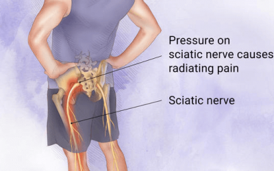 Sciatica Treatment
